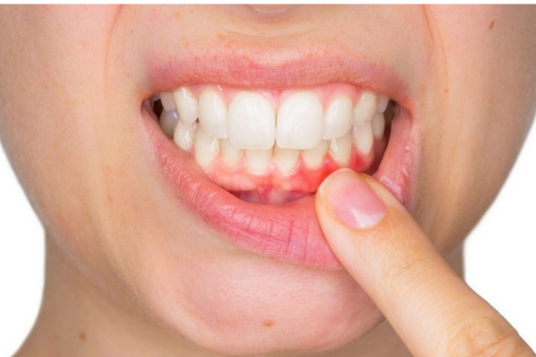 Thường xuyên viêm nướu gây chảy máu chân răng và hôi miệng - Nên làm gì?
